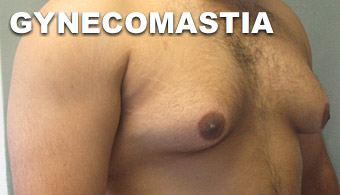 gynecomastia