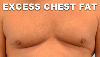 male breasts