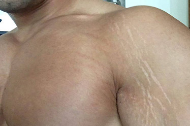 stretch marks from gaining muscle